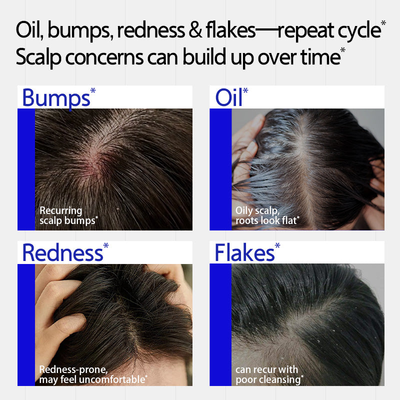 EHD Oil Control and Acne-Fighting Shampoo