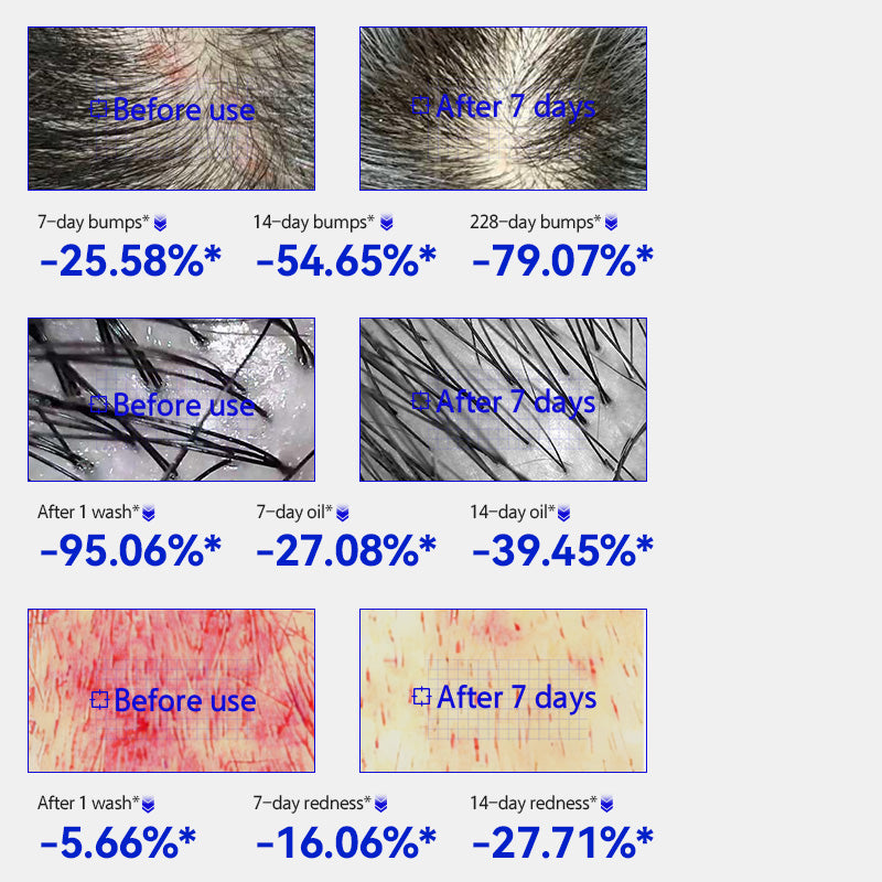 EHD Oil Control and Acne-Fighting Shampoo